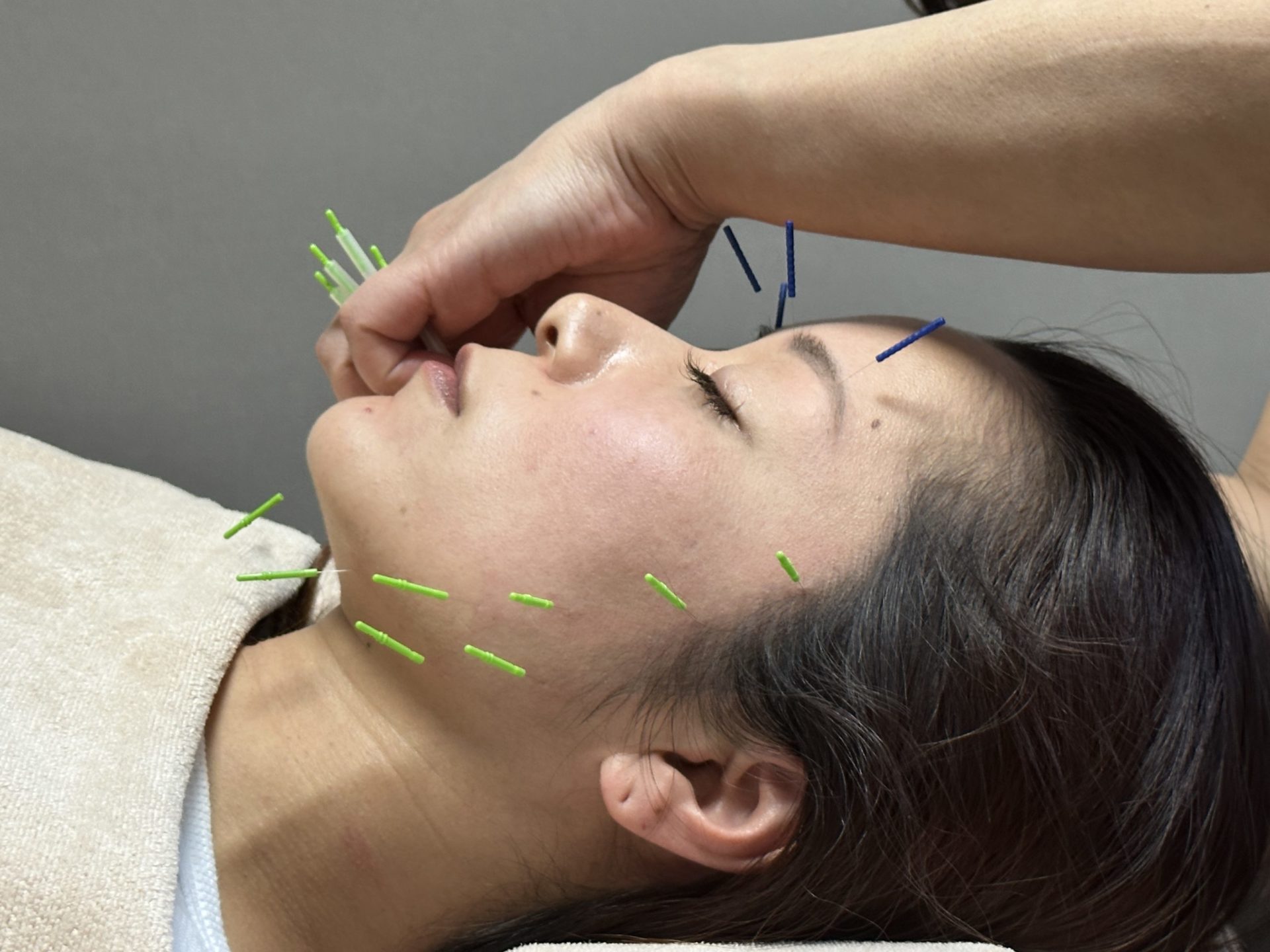 美容鍼施術